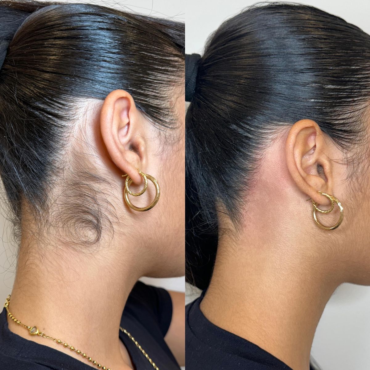 Neck & hairline · Week 0 → Week 12